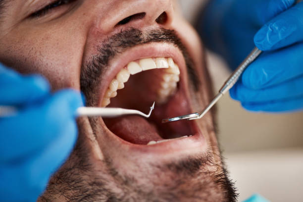 Best Emergency Dental Care for Broken or Chipped Teeth in Shippensburg University, PA