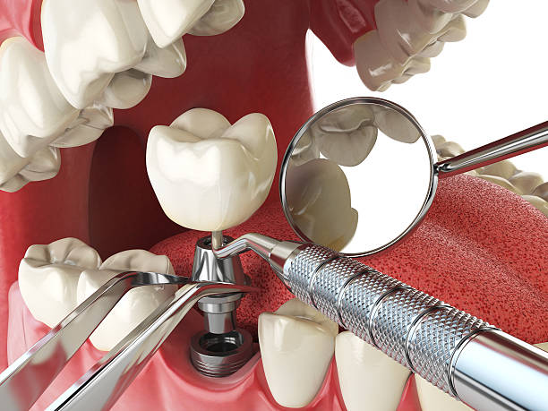 Best Emergency Tooth Extraction in Shippensburg University, PA